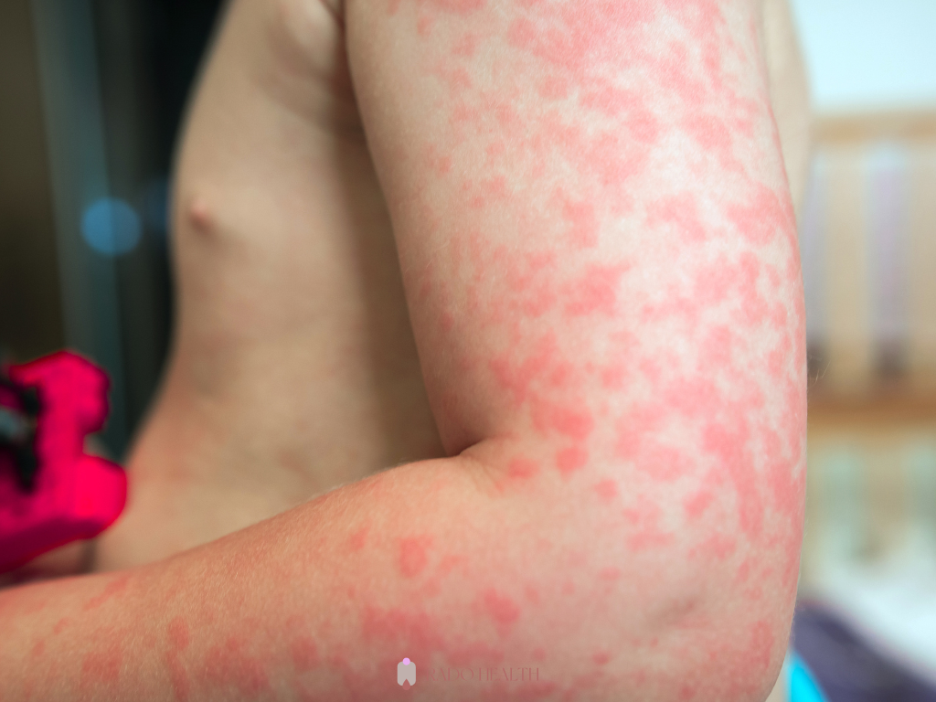 simptomi alergije na gluten